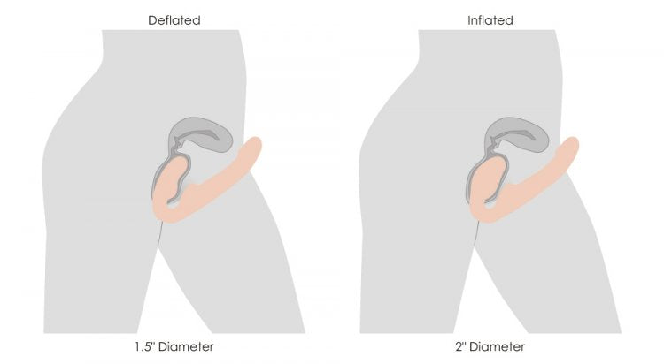 Two illustrations shown side by side show the wearer with the wearer's bulb of the Strap U Ergo-Fit Inflatable & Vibrating Strapless Strap-On inserted inside of them. In one, the toy is fully deflated at a 1.5" diameter. In the other, the toy is fully inflated at a 2" diameter. | Kinkly Shop