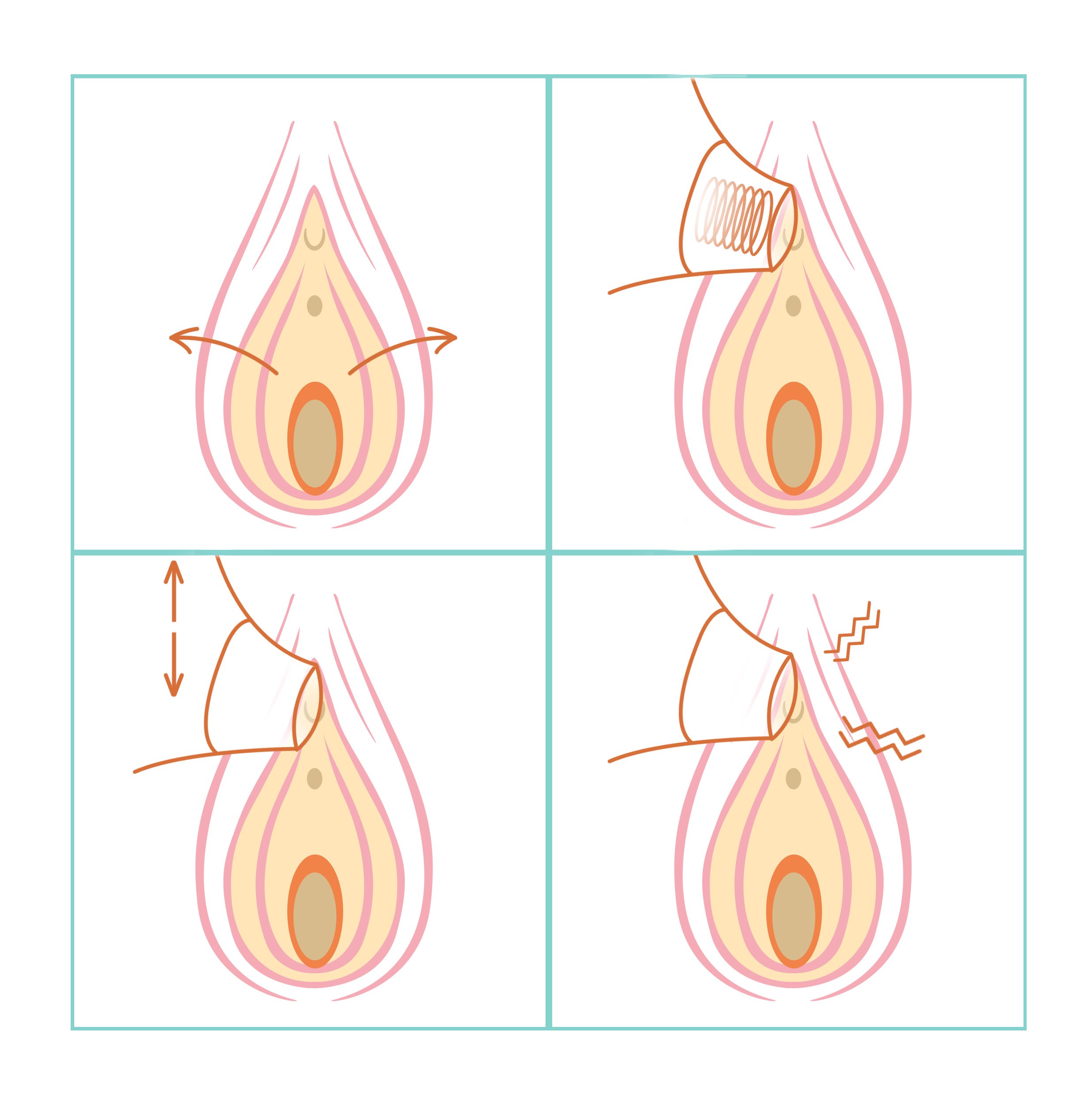 A four-panel diagram showing a suction sex toy operating on a vulva. In the first panel, arrows point outward from the vulva's lips to indicate spreading legs. In the second panel, the a suction toy is applied to the clitoris with a spiral inside of it. In the third panel, arrows point upward and downward from the suction toy. In the fourth panel, squiggly lines emerge from the head of the suction toy to indicate vibrations. 