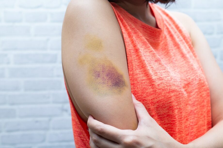 What to Do About Your Sexy Bruises
